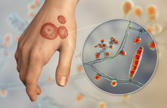 Drug-resistant ringworm cases triple as fungus spreads to 29 countries, CDC finds