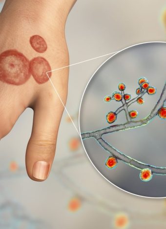 Drug-resistant ringworm cases triple as fungus spreads to 29 countries, CDC finds